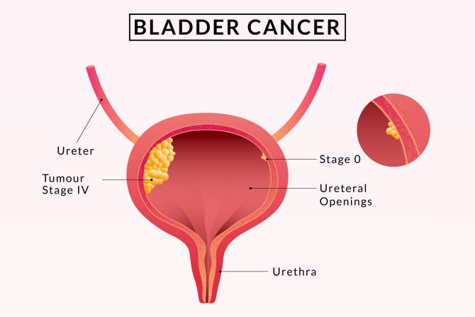 Bladder Cancer: Signs, Symptoms, Causes & Treatments